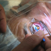 Behandeling van cataract
