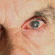 Oorzaken cataract